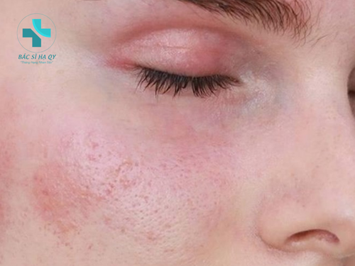 Azelaic acid không thể sử dụng cho mọi loại da, cần tham khảo ý kiến bác sĩ trước khi dùng