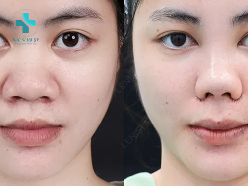 Các phương án phẫu thuật mũi to thành nhỏ, đạt được dáng mũi thanh tú tự nhiên 3