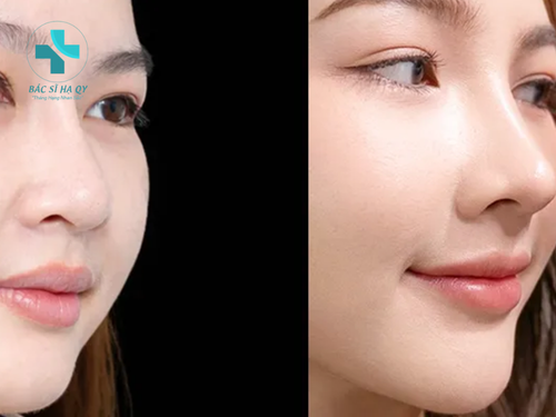 Các phương án phẫu thuật mũi to thành nhỏ, đạt được dáng mũi thanh tú tự nhiên 5